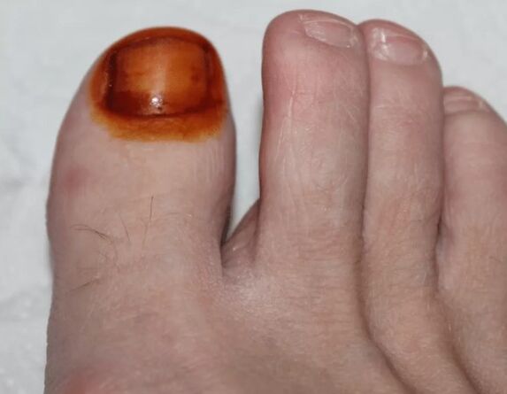 Leczenie jodu grzybowego