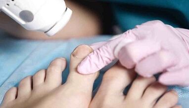 Traktowanie grzybów na nogach