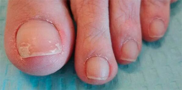 Etapy nóg grzybowych