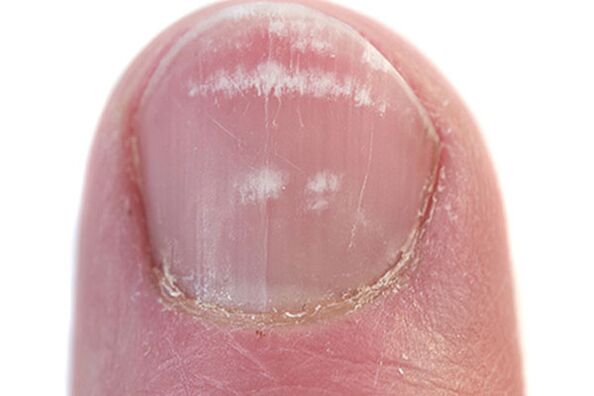 Pierwsze oznaki i objawy